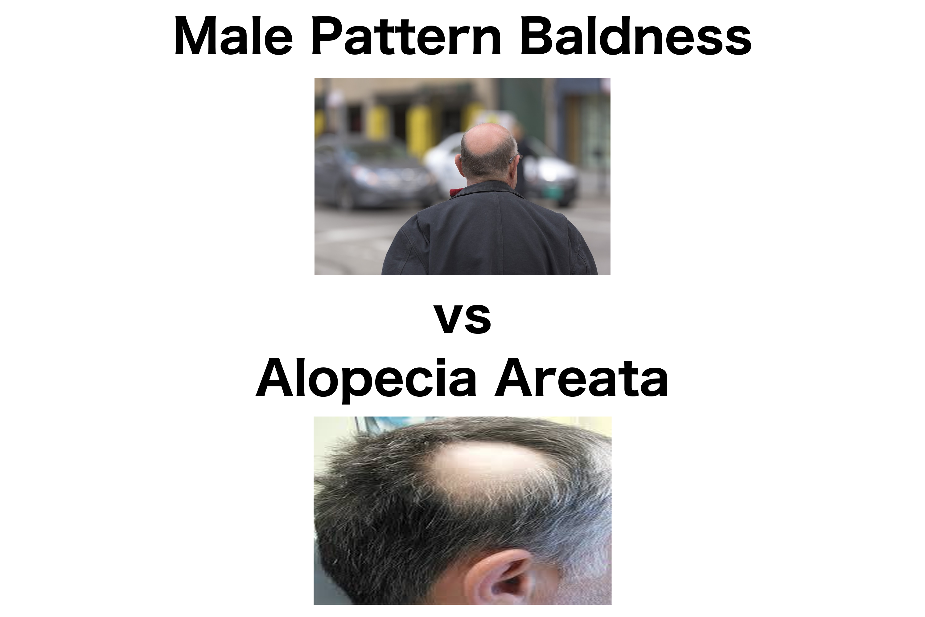 alopecia universalis vs alopecia areata